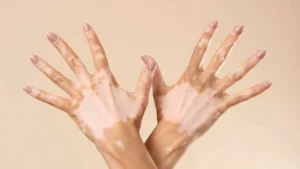 Mão de uma pessoa com vitiligo